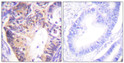 Immunohistochemistry analysis of paraffin-embedded human colon carcinoma tissue, using PAK1 Antibody. The picture on the right is blocked with the synthesized peptide.