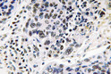 Immunohistochemistry analysis of Pax-8 antibody in paraffin-embedded human lung carcinoma tissue.