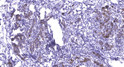 Immunohistochemical analysis of paraffin-embedded human breast cancer. 1, Antibody was diluted at 1:200 (4° overnight). STJ95049