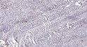 Immunohistochemical analysis of paraffin-embedded human colon cancer. 1, Antibody was diluted at 1:200 (4° overnight). STJ95054
