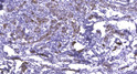 Immunohistochemical analysis of paraffin-embedded human breast cancer. 1, Antibody was diluted at 1:200 (4° overnight). STJ95061