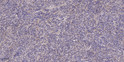 Immunohistochemical analysis of paraffin-embedded human colon cancer. 1, Antibody was diluted at 1:200 (4° overnight). STJ95072