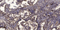 Immunohistochemical analysis of paraffin-embedded human squamous cell carcinoma of lung. 1, Antibody was diluted at STJ95101