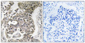 Immunohistochemistry analysis of paraffin-embedded human breast carcinoma tissue, using PPP2R1B Antibody. The picture on the right is blocked with the synthesized peptide.