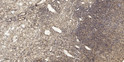 Immunohistochemical analysis of paraffin-embedded human oophoroma. 1, Antibody was diluted at 1:200 (4° overnight). 2, STJ95193