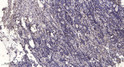 Immunohistochemical analysis of paraffin-embedded human gastric adenocarcinoma. 1, Antibody was diluted at 1:200 (4° STJ95196