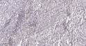 Immunohistochemical analysis of paraffin-embedded human colon cancer. 1, Antibody was diluted at 1:200 (4° overnight). STJ95198