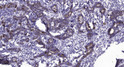 Immunohistochemical analysis of paraffin-embedded human breast cancer. 1, Antibody was diluted at 1:200 (4° overnight). STJ95264