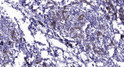 Immunohistochemical analysis of paraffin-embedded human breast cancer. 1, Antibody was diluted at 1:200 (4° overnight). STJ95284