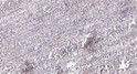 Immunohistochemical analysis of paraffin-embedded human colon cancer. 1, Antibody was diluted at 1:200 (4° overnight). STJ95286