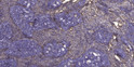 Immunohistochemical analysis of paraffin-embedded human cervical carcinoma. 1, Antibody was diluted at 1:200 (4° STJ95304