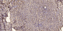 Immunohistochemical analysis of paraffin-embedded human liver cancer. 1, Antibody was diluted at 1:200 (4° overnight). STJ95316