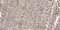 Immunohistochemical analysis of paraffin-embedded human small intestinal carcinoma tissue. 1, Primary antibody was STJ95332