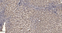 Immunohistochemical analysis of paraffin-embedded human liver cancer. 1, Antibody was diluted at 1:200 (4° overnight). STJ95365