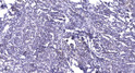 Immunohistochemical analysis of paraffin-embedded human breast cancer. 1, Antibody was diluted at 1:200 (4° overnight). STJ95369