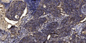 Immunohistochemical analysis of paraffin-embedded human squamous cell carcinoma of lung. 1, Antibody was diluted at STJ95371