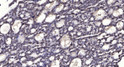 Immunohistochemical analysis of paraffin-embedded human liver cancer. 1, Antibody was diluted at 1:200 (4° overnight). STJ95390
