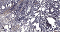 Immunohistochemical analysis of paraffin-embedded human gastric adenocarcinoma. 1, Antibody was diluted at 1:200 (4° STJ95394