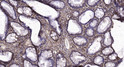 Immunohistochemical analysis of paraffin-embedded human colon cancer. 1, Tris-EDTA, pH 9.0 was used for antigen STJ95403