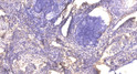 Immunohistochemical analysis of paraffin-embedded human cervical carcinoma. 1, Antibody was diluted at 1:200 (4° STJ95416