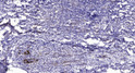 Immunohistochemical analysis of paraffin-embedded human breast cancer. 1, Antibody was diluted at 1:200 (4° overnight). STJ95417