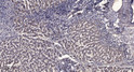 Immunohistochemical analysis of paraffin-embedded human liver cancer. 1, Antibody was diluted at 1:200 (4° overnight). STJ95469