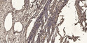 Immunohistochemical analysis of paraffin-embedded human oophoroma. 1, Antibody was diluted at 1:200 (4° overnight). 2, STJ95493