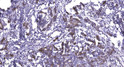Immunohistochemical analysis of paraffin-embedded human breast cancer. 1, Antibody was diluted at 1:200 (4° overnight). STJ95502