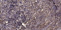 Immunohistochemical analysis of paraffin-embedded human squamous cell carcinoma of lung. 1, Antibody was diluted at STJ95524