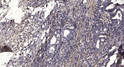 Immunohistochemical analysis of paraffin-embedded human gastric adenocarcinoma. 1, Antibody was diluted at 1:200 (4°C STJ95529