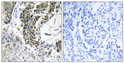 Immunohistochemistry analysis of paraffin-embedded human lung carcinoma tissue, using RREB1 Antibody. The picture on the right is blocked with the synthesized peptide.
