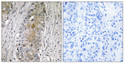 Immunohistochemistry analysis of paraffin-embedded human lung carcinoma, using SAA4 Antibody. The picture on the right is blocked with the synthesized peptide.