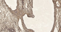 Immunohistochemical analysis of paraffin-embedded human oophoroma. 1, Antibody was diluted at 1:200 (4°C overnight). 2, STJ95592