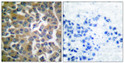 Immunohistochemistry analysis of paraffin-embedded human breast carcinoma tissue, using FAP-1 Antibody. The picture on STJ95609