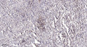 Immunohistochemical analysis of paraffin-embedded human colon cancer. 1, Antibody was diluted at 1:200 (4° overnight). STJ95612