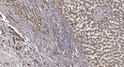 Immunohistochemical analysis of paraffin-embedded human liver cancer. 1, Antibody was diluted at 1:200 (4° overnight). STJ95622