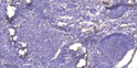 Immunohistochemical analysis of paraffin-embedded human cervical carcinoma. 1, Antibody was diluted at 1:200 (4° STJ95631