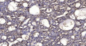 Immunohistochemical analysis of paraffin-embedded human liver cancer. 1, Antibody was diluted at 1:200 (4° overnight). STJ95649
