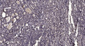 Immunohistochemical analysis of paraffin-embedded human gastric adenocarcinoma. 1, Antibody was diluted at 1:200 (4°C STJ95670