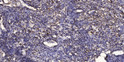 Immunohistochemical analysis of paraffin-embedded human squamous cell carcinoma of the lung. 1, Antibody was diluted at STJ95674