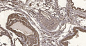 Immunohistochemical analysis of paraffin-embedded human oophoroma. 1, Antibody was diluted at 1:200 (4°C overnight). 2, STJ95678