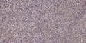 Immunohistochemical analysis of paraffin-embedded human colon cancer. 1, Antibody was diluted at 1:200 (4° overnight). STJ95680