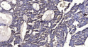 Immunohistochemical analysis of paraffin-embedded human liver cancer. 1, Antibody was diluted at 1:200 (4° overnight). STJ95682