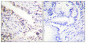 Immunohistochemical analysis of paraffin-embedded Human breast cancer. Antibody was diluted at 1:100 (4°C overnight). High-pressure and temperature Tris-EDTA, pH8.0 was used for antigen retrieval. Negetive contrl (right) obtaned from antibody was pre-absorbed by immunogen peptide.