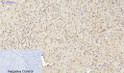 Immunohistochemical analysis of paraffin-embedded Human-uterus-cancer tissue. 1, Smad2 Polyclonal Antibody was diluted at 1:200 (4°C, overnight). 2, Sodium citrate pH 6.0 was used for antibody retrieval (>98°C, 20min). 3, Secondary antibody was diluted at 1:200 (room tempeRature, 30min). Negative control was used by secondary antibody only.