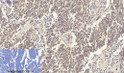 Immunohistochemical analysis of paraffin-embedded Human-lung-cancer tissue. 1, Smad2 Polyclonal Antibody was diluted at 1:200 (4°C, overnight). 2, Sodium citrate pH 6.0 was used for antibody retrieval (>98°C, 20min). 3, Secondary antibody was diluted at 1:200 (room tempeRature, 30min). Negative control was used by secondary antibody only.