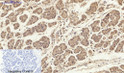 Immunohistochemical analysis of paraffin-embedded Human-stomach-cancer tissue. 1, Smad2 Polyclonal Antibody was diluted at 1:200 (4°C, overnight). 2, Sodium citrate pH 6.0 was used for antibody retrieval (>98°C, 20min). 3, Secondary antibody was diluted at 1:200 (room tempeRature, 30min). Negative control was used by secondary antibody only.