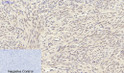 Immunohistochemical analysis of paraffin-embedded Human-uterus tissue. 1, Smad3 Polyclonal Antibody was diluted at 1:200 (4°C, overnight). 2, Sodium citrate pH 6.0 was used for antibody retrieval (>98°C, 20min). 3, Secondary antibody was diluted at 1:200 (room tempeRature, 30min). Negative control was used by secondary antibody only.