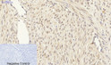 Immunohistochemical analysis of paraffin-embedded Human-uterus-cancer tissue. 1, Smad3 Polyclonal Antibody was diluted at 1:200 (4°C, overnight). 2, Sodium citrate pH 6.0 was used for antibody retrieval (>98°C, 20min). 3, Secondary antibody was diluted at 1:200 (room tempeRature, 30min). Negative control was used by secondary antibody only.
