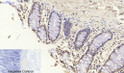 Immunohistochemical analysis of paraffin-embedded Human-colon tissue. 1, Smad3 Polyclonal Antibody was diluted at 1:200 (4°C, overnight). 2, Sodium citrate pH 6.0 was used for antibody retrieval (>98°C, 20min). 3, Secondary antibody was diluted at 1:200 (room tempeRature, 30min). Negative control was used by secondary antibody only.